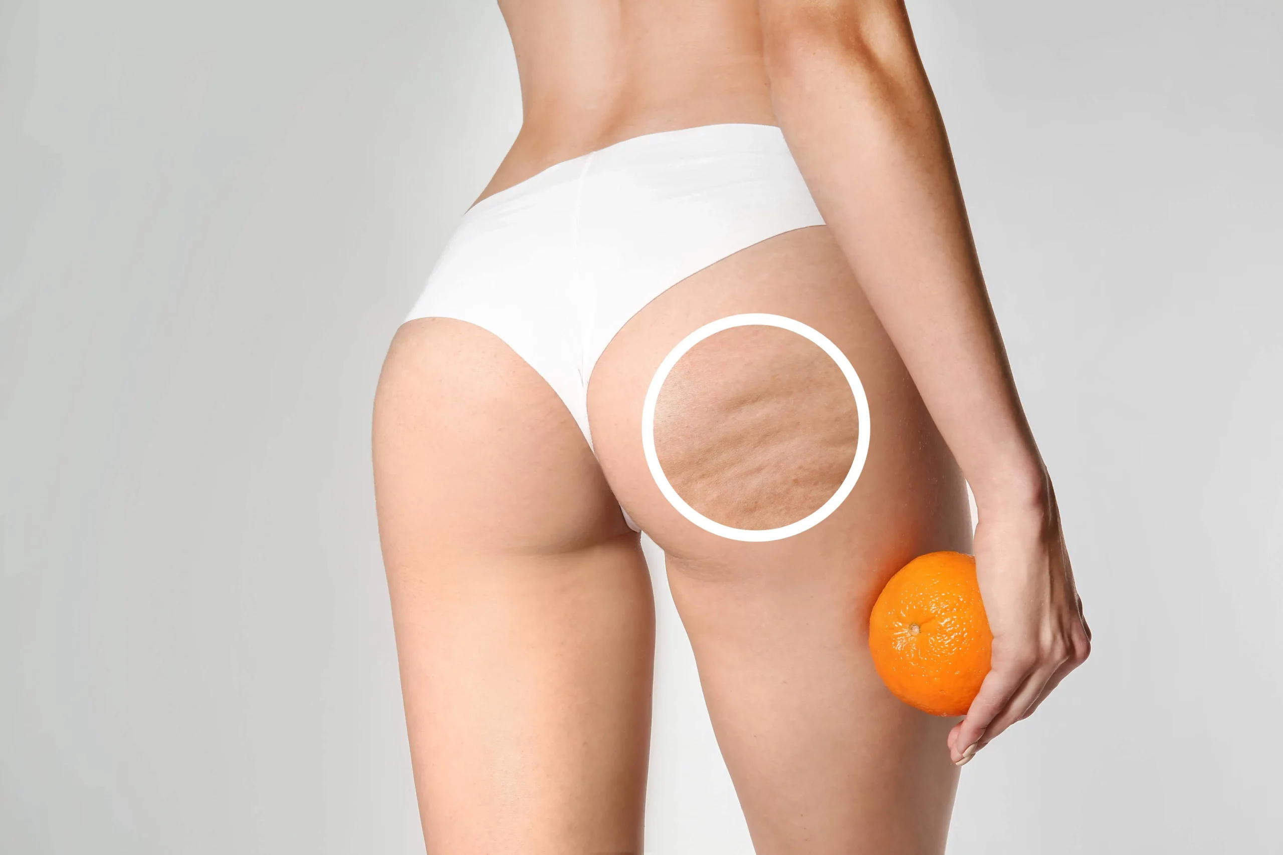 Cellulite Treatment Service by Dr Grossman in NY US scaled