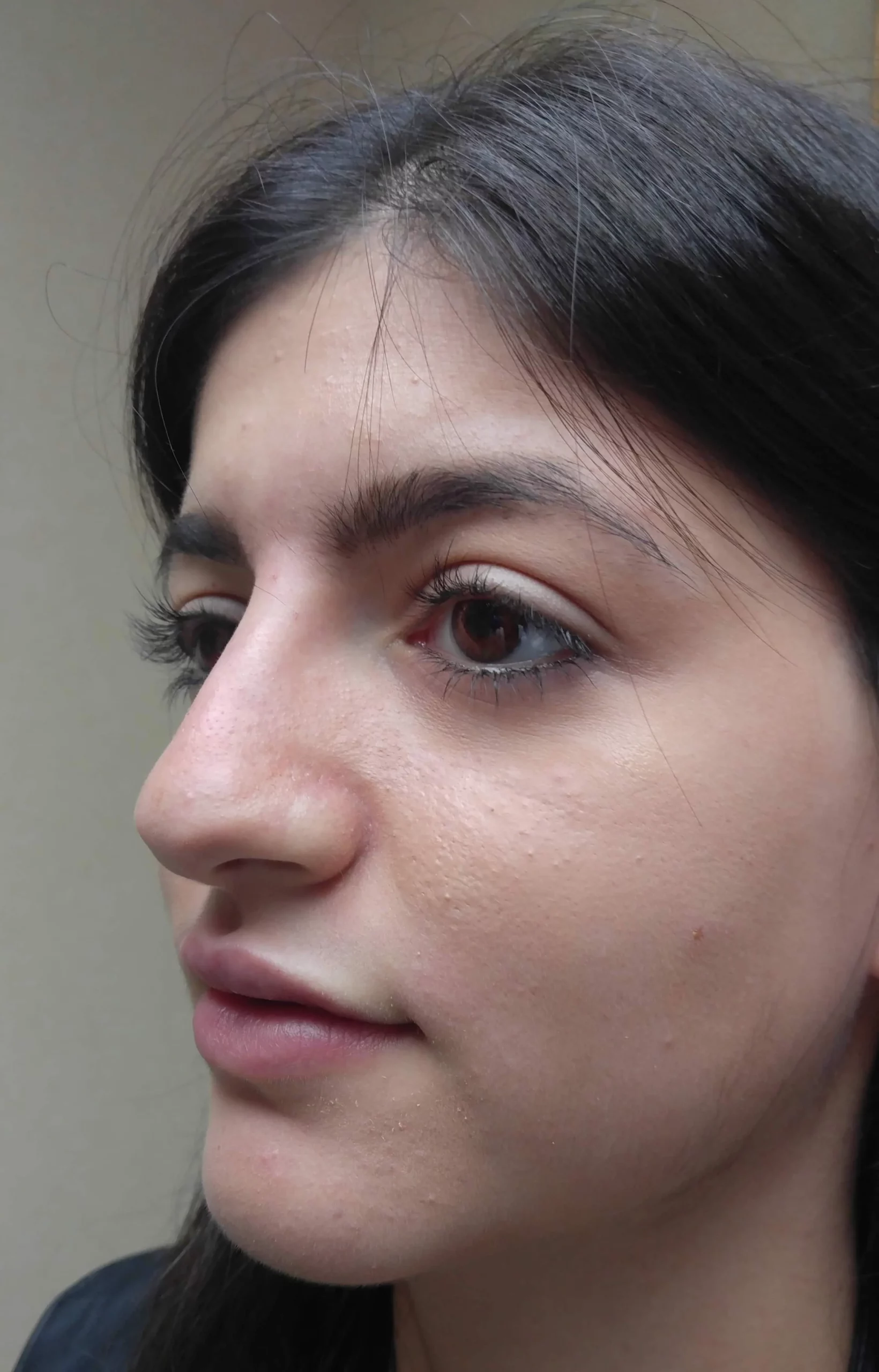 Liquid Nose Job After by Dr Grossman in NY US scaled