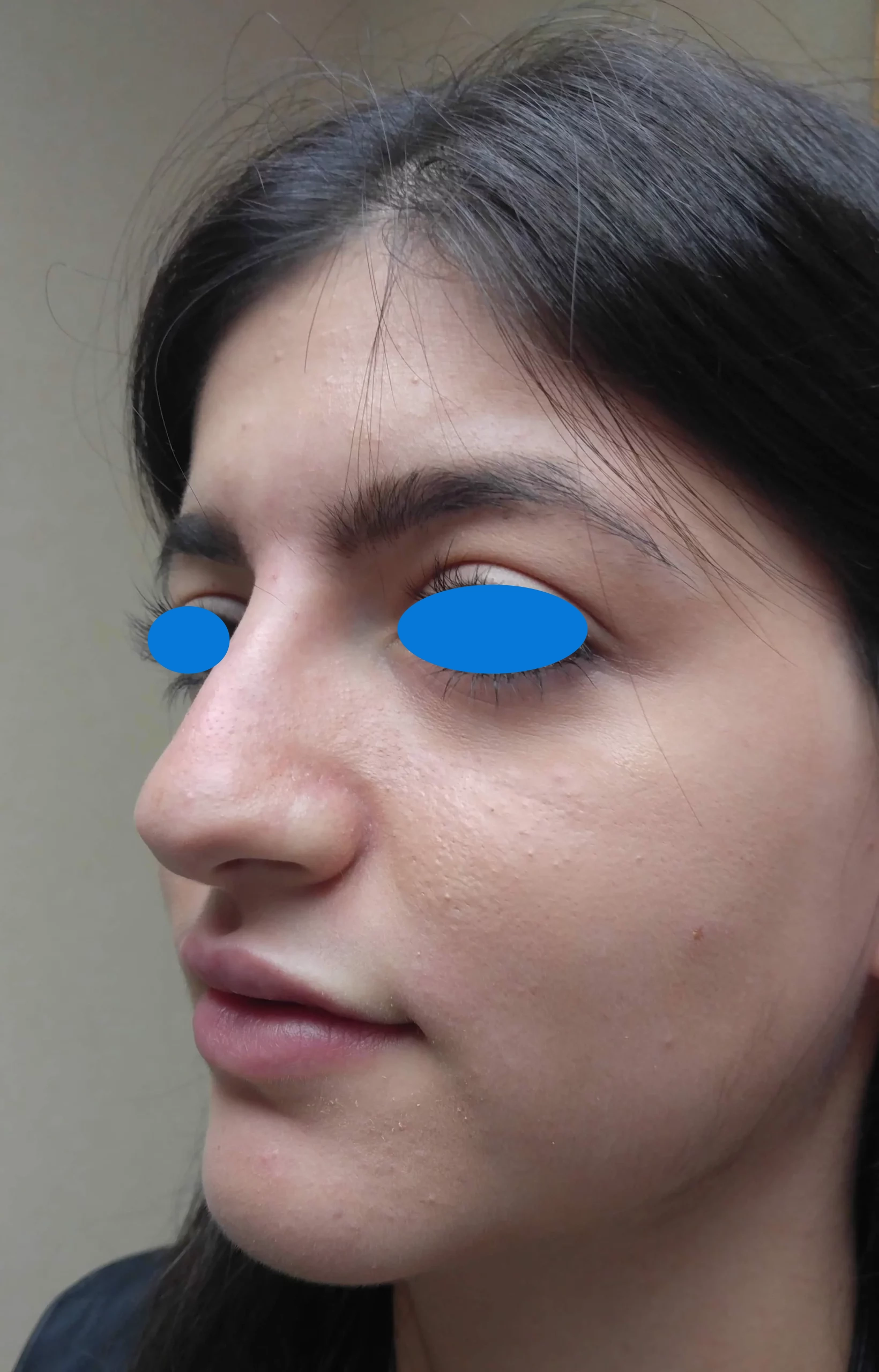 Liquid Nose Job After | Liquid Nose Job