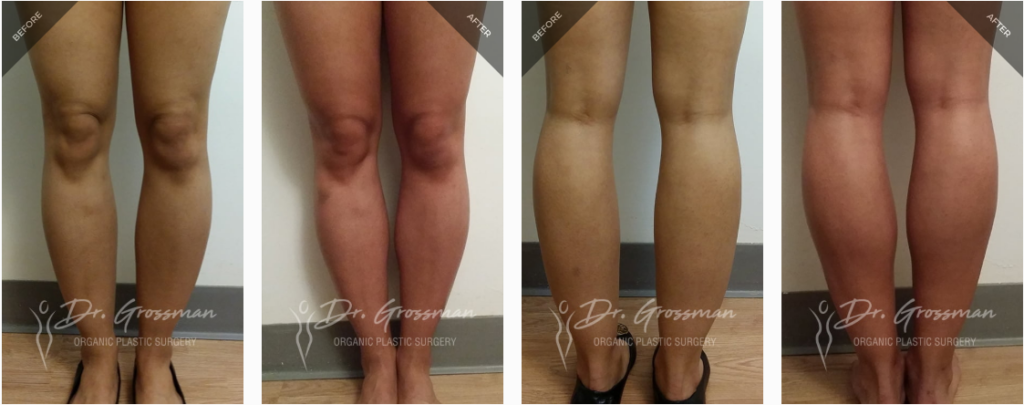 Calf and Ankle Liposuction/ Reduction before & after