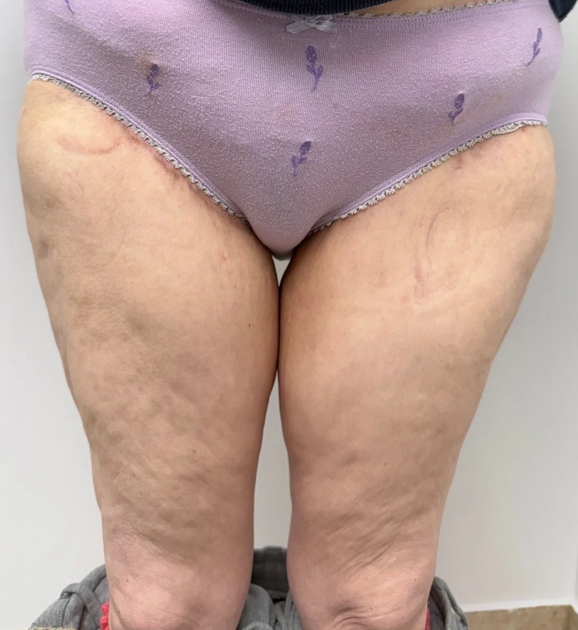 post thigh lift front | Thigh Lift