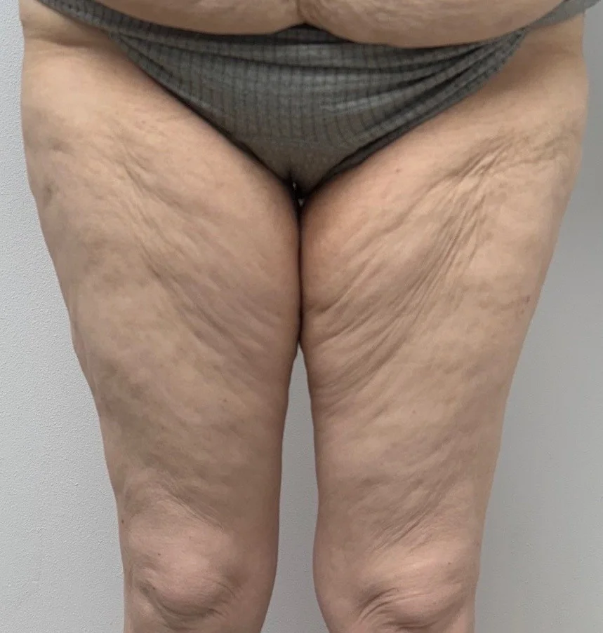 thigh lift pre front | Thigh Lift