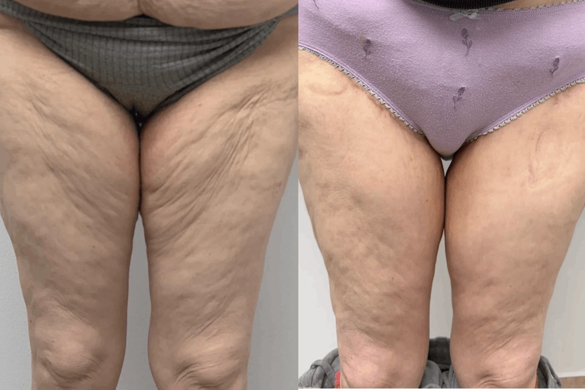 Thigh Lift Before and After