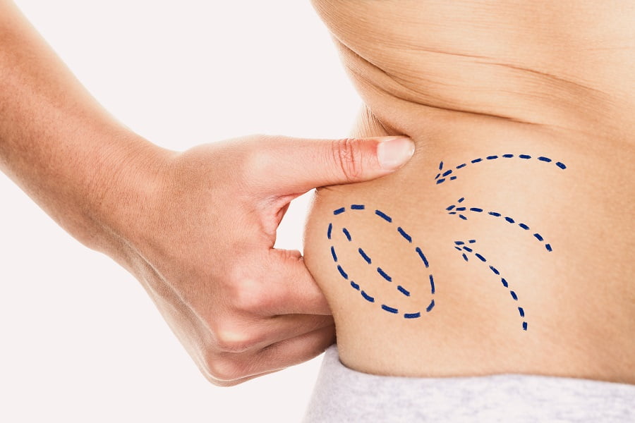 Liposucation | Dr. Leonard Grossman M.D. | NY