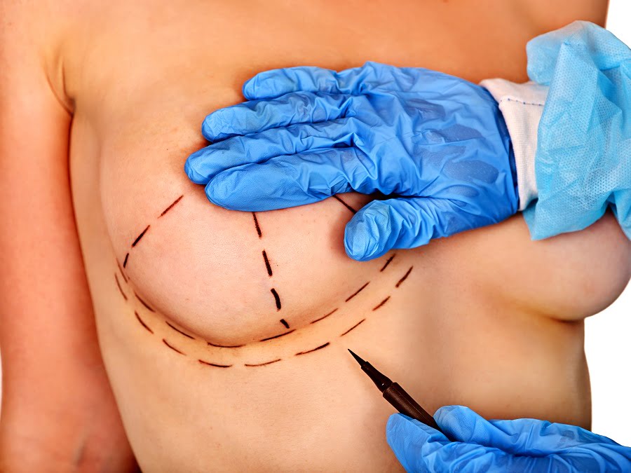 Breast cancer surgery | Dr. Leonard Grossman M.D. | NY