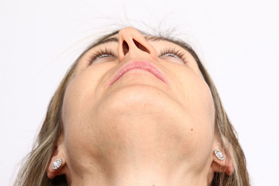 A Woman showing her nose | Dr. Leonard Grossman M.D. | New York
