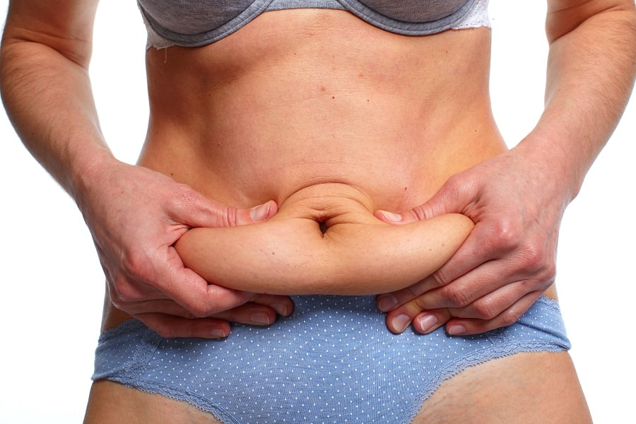 Woman fat belly | Dr. Leonard Grossman M.D. | NY