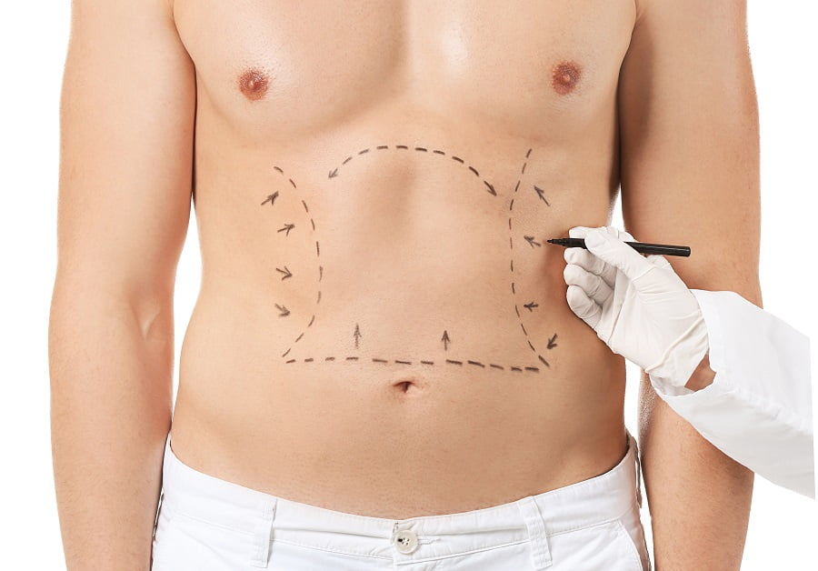 A Man getting ready for Tummy Tuck treatment | Dr. Leonard Grossman M.D. | New York