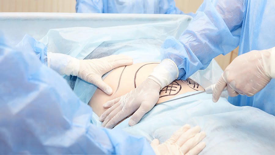 Tummy Tuck Surgery | Dr. Leonard Grossman M.D. | NY