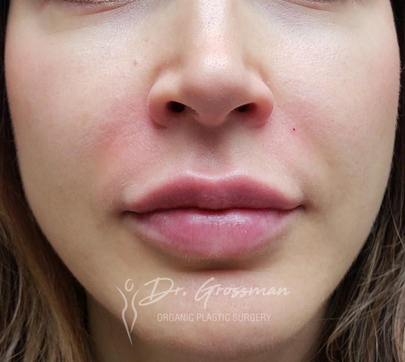 Lip Augmentation / Reshaping 30 1 1 4