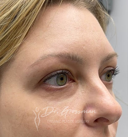 Facial Rejuvenation 84 1 11 1