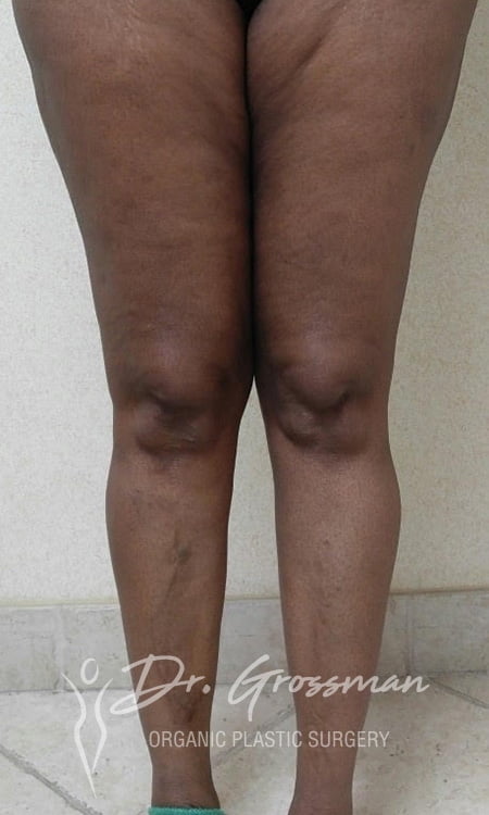 Calf Augmentation with Fat 41 Calf Augmentation | New York City Plastic Surgery PC