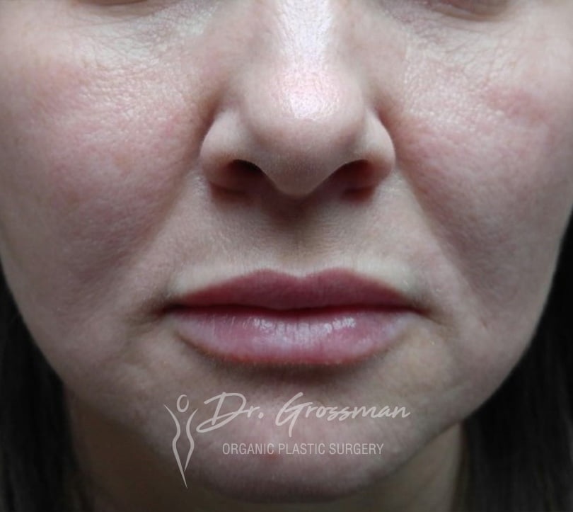 Lip Augmentation / Reshaping 34 1 25