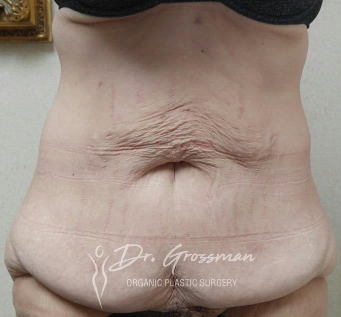 Best Tummy Tuck NYC 31 Before Tummy tuck | New York City Plastic Surgery PC