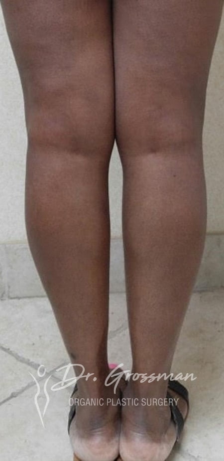 Girls showing her legs | New York City Plastic Surgery PC