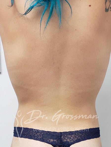 Liposuction 93 2 1 11