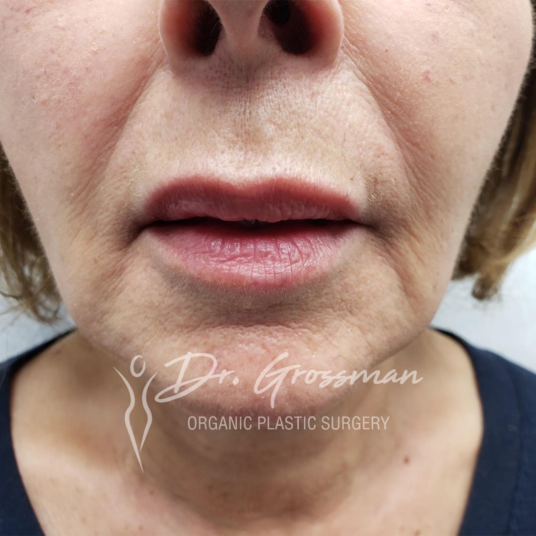 Lip Augmentation / Reshaping | New York City Plastic Surgery PC