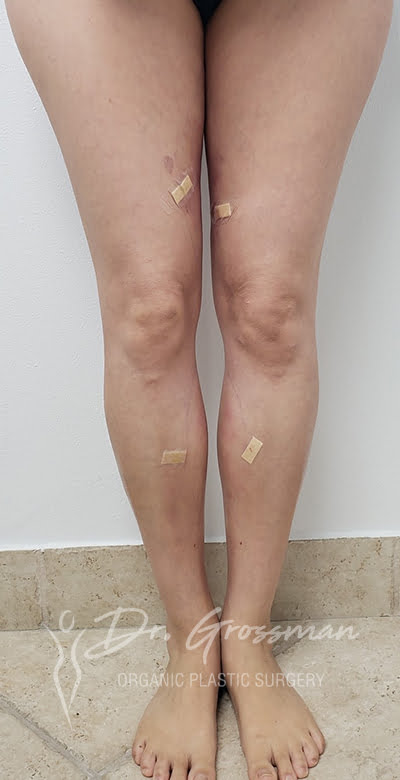 Fat Grafting Treatments in NYC 4 2 18