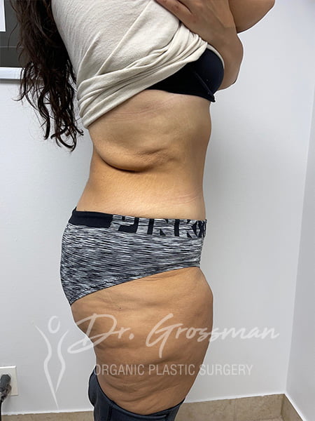 Best Tummy Tuck NYC 52 2 2 3