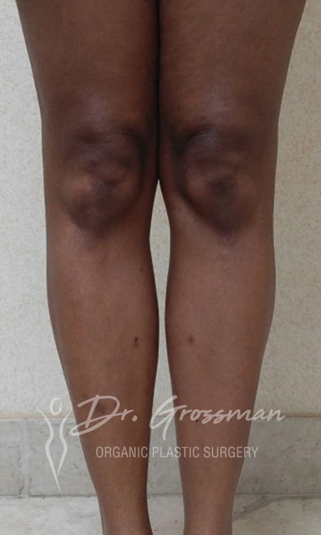 Calf Augmentation with Fat 143 2 9