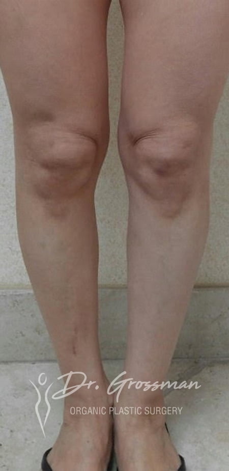 Calf and Ankle Liposuction/ Reduction 8 Leg surgery | New York City Plastic Surgery PC