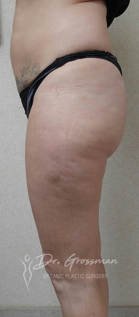 Brazilian Butt Lift in New York 95 3 26