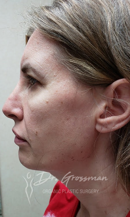 Facial Rejuvenation 107 4 20