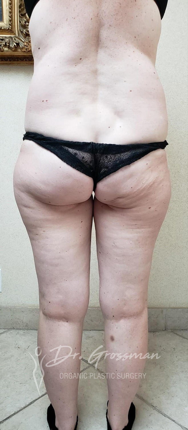 Brazilian Butt Lift in New York 50 4 3 3