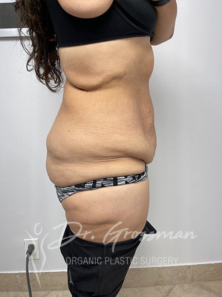 Best Tummy Tuck NYC 51 7