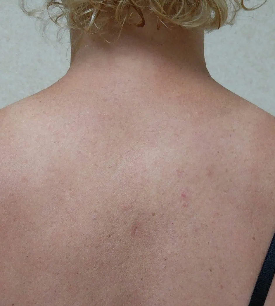 Buffalo Hump Treatment Liposuction After by Dr Grossman in NY US | Portfolio