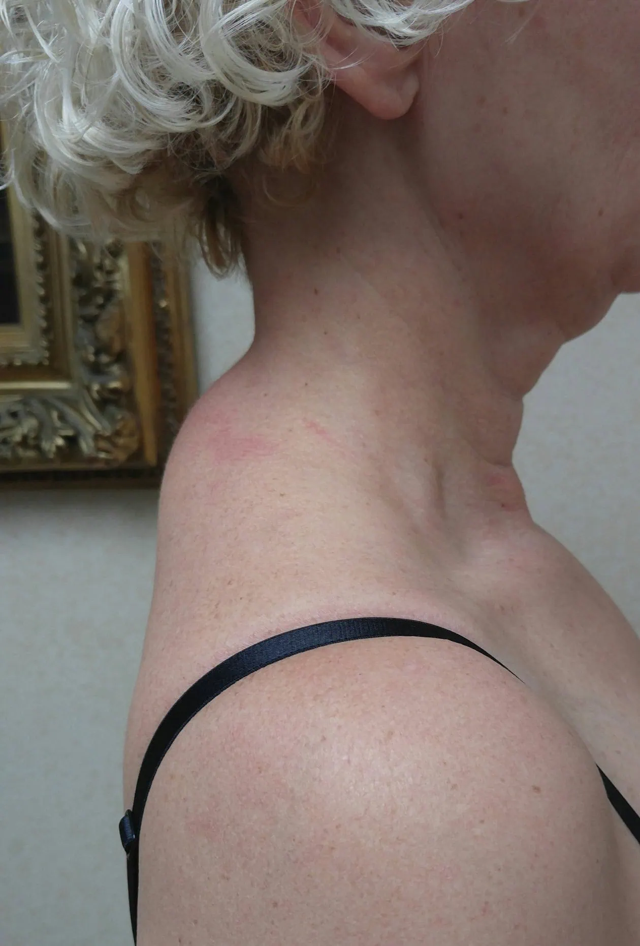Buffalo Hump Treatment Liposuction Before Two by Dr Grossman in NY US | Portfolio