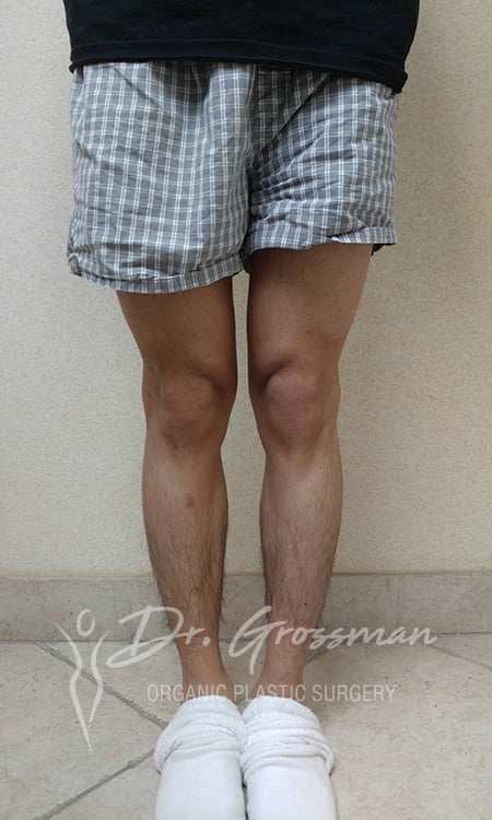 Calf augmentation with fat before 1