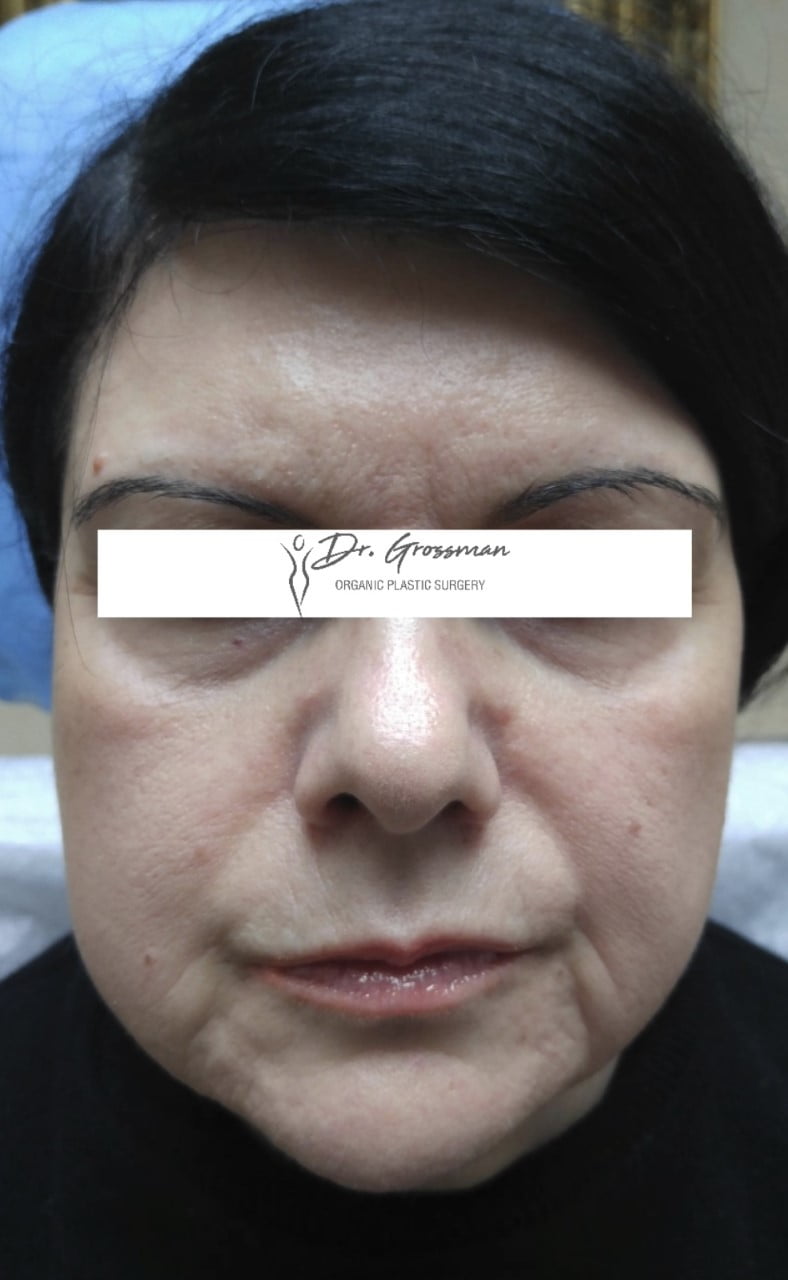 Facial Rejuvenation 31 FACIAL REJUVENATION212