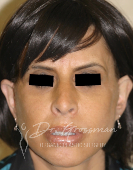 Before and After Face Rejuvenation | New York City Plastic Surgery PC