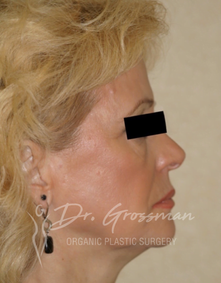 Fat Transfer and Facial Rejuvenation 32 Before and After Face Rejuvenation | New York City Plastic Surgery PC