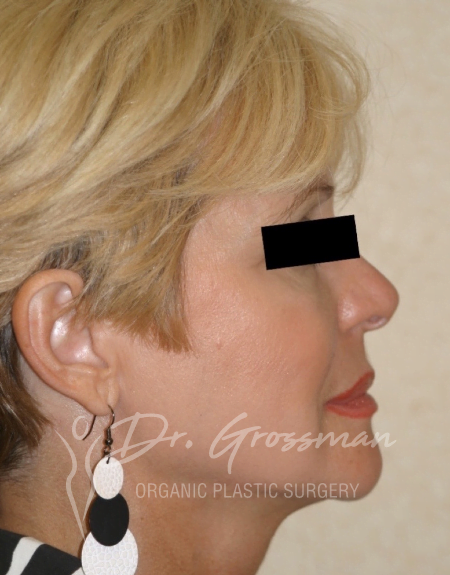 Fat Transfer and Facial Rejuvenation 33 Before and After Face Rejuvenation | New York City Plastic Surgery PC