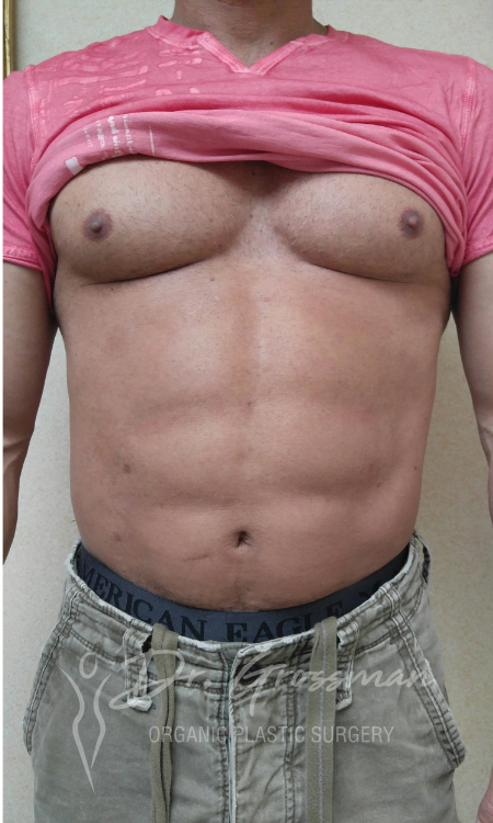 Abdominal Etching 14 Abdominal etching Treatment | New York City Plastic Surgery PC