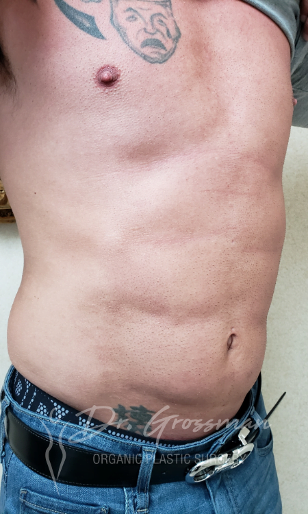 After Abdominal Lipoetching Treatment