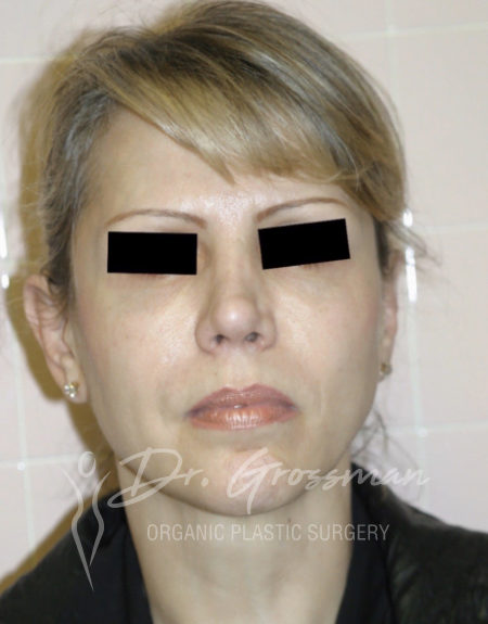 Facial Rejuvenation 24 After Face Rejuvenation | New York City Plastic Surgery PC