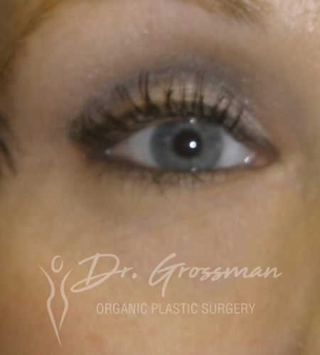 After Fat Transfer to Lower eye | New York City Plastic Surgery PC
