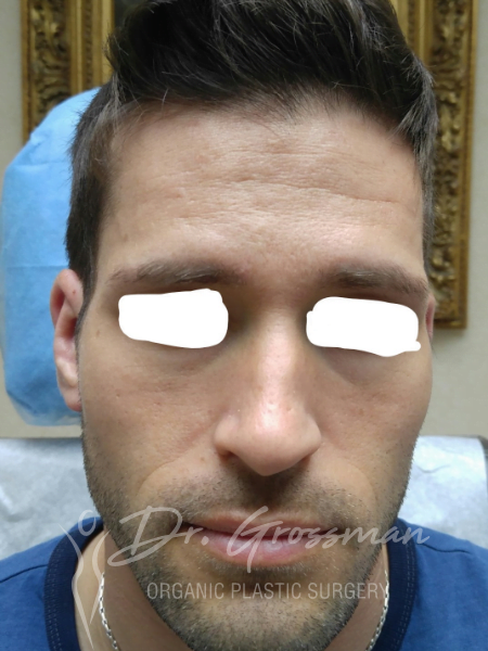 Otoplasty (ear reshaping) 13 after otoplasty plastic surgeon emmons ave brooklyn new york ny drgrossman