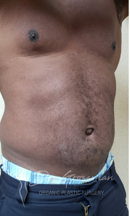 Abdominal Etching 29 Before Abdominal Lipoetching Treatment