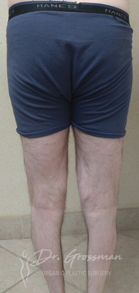 Calf Augmentation with Fat 105 Before Calf Augmentation Treatment Fat Service