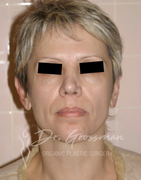 Before Face Rejuvenation with Fat-Treatment