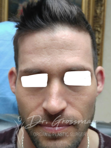 before otoplasty ear reshaping service treatment plastic surgeon emmons ave brooklyn new york ny drgrossman