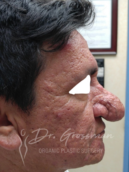 Rhinoplasty 6 before rhinophyma reduction with j plasma renuvion plastic surgeon emmons ave brooklyn new york ny drgrossman
