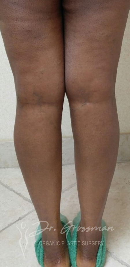 Bowed Leg Surgery 26 Bowed Leg Correction | New York City Plastic Surgery PC