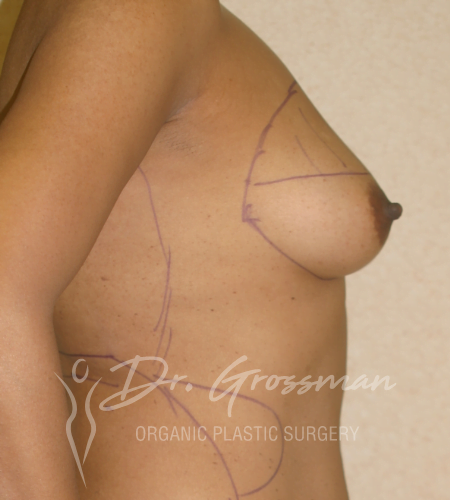 Breast Augmentation with Fat | New York City Plastic Surgery PC