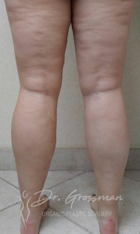 Cankle Liposuction in New York City Plastic Surgery PC