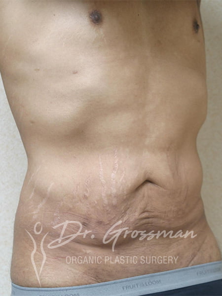 Best Tummy Tuck NYC 3 drgrossman tummu tuck 3